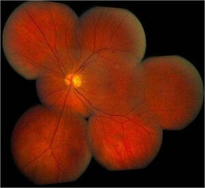 Image Stitching of the Retina