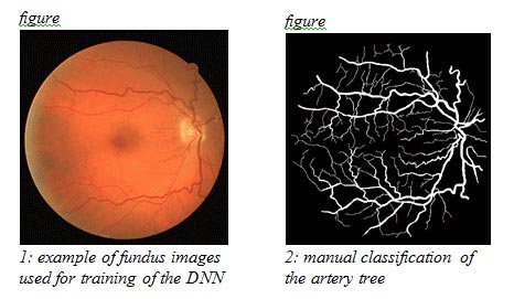 Deep Learning for Vessel Segmentation in Fundus Images