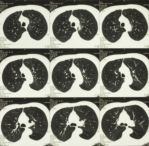 Lung CT scans