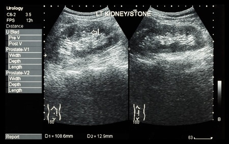 Ultrasonography of kidney showing left kidney stone