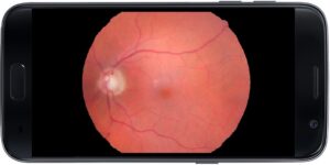 Retinal image with smartphone