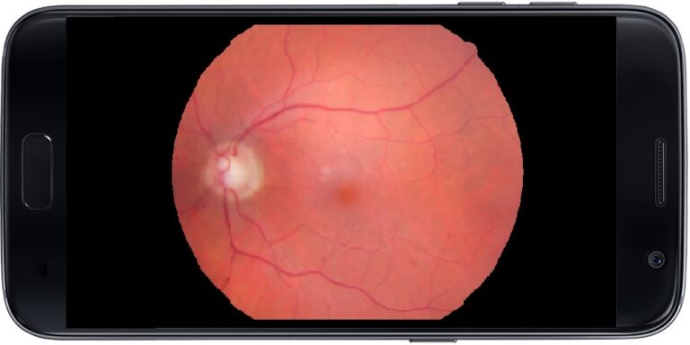 Retinal image with smartphone