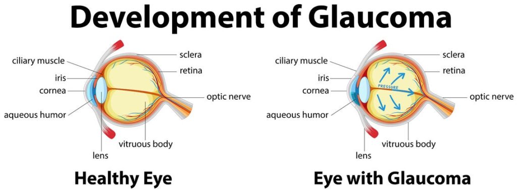 Eye with Glaucoma