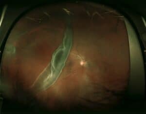 Giant Retinal Tear