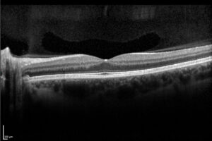 Spectral Domain Optical Coherence Tomography (SD-OCT)