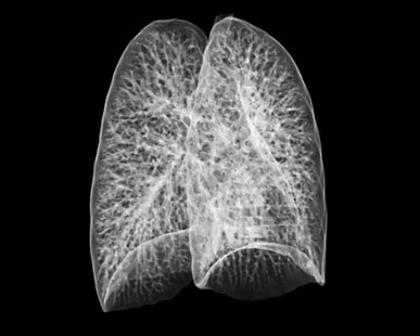 CT scan of healthy lungs