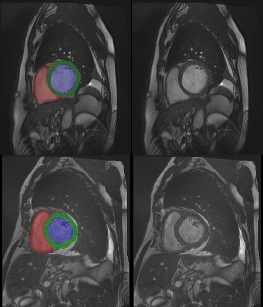 Cardiac MRI 3D automatic segmentation