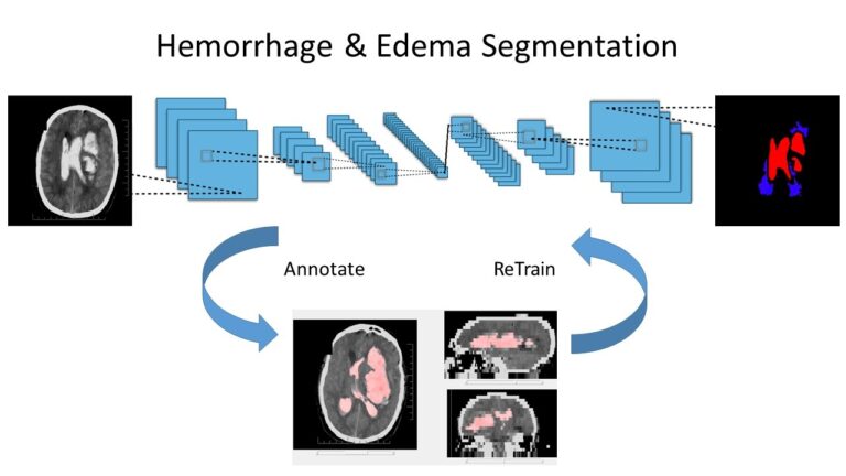 Hemorrhage and Edema segmentation with Deep Learning
