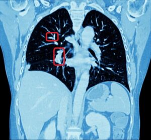 Visible lung cancer on CT scan of chest and abdomen