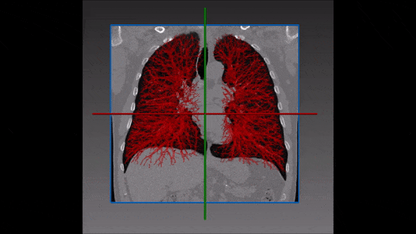 Lung vessels segmentation