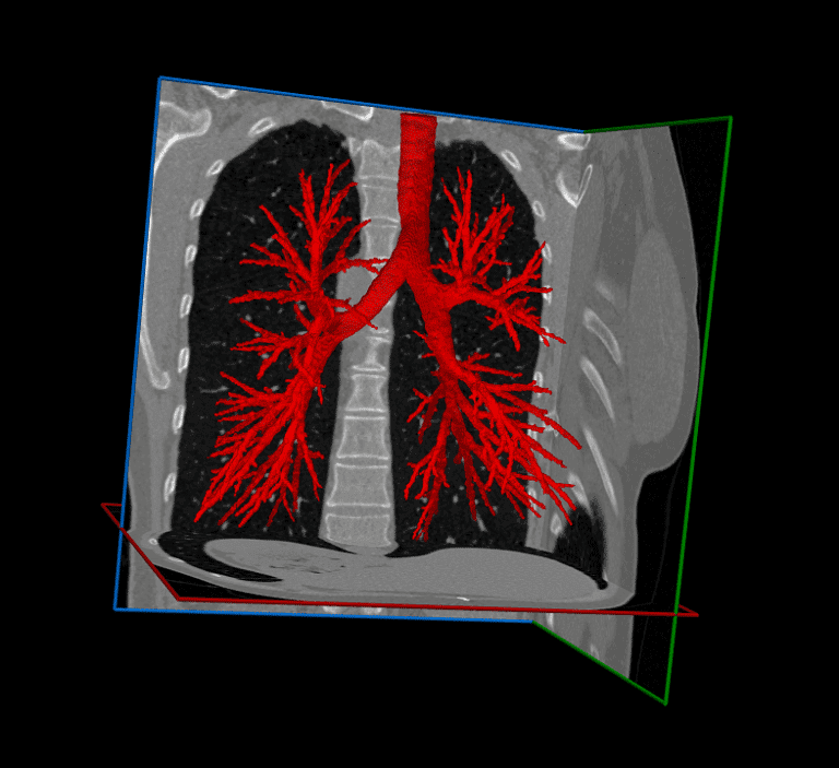 Lung Segmentation