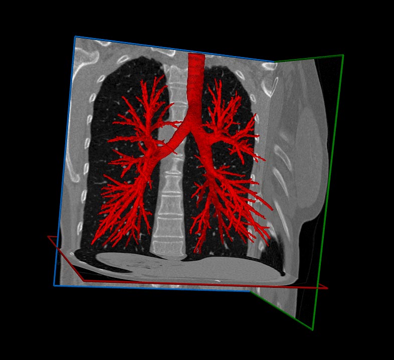 Lung Segmentation