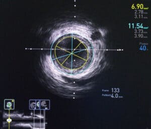 Intravenous Ultrasound