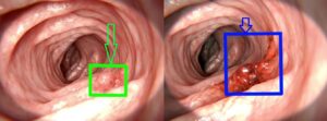 Endoscopy with cancer detection