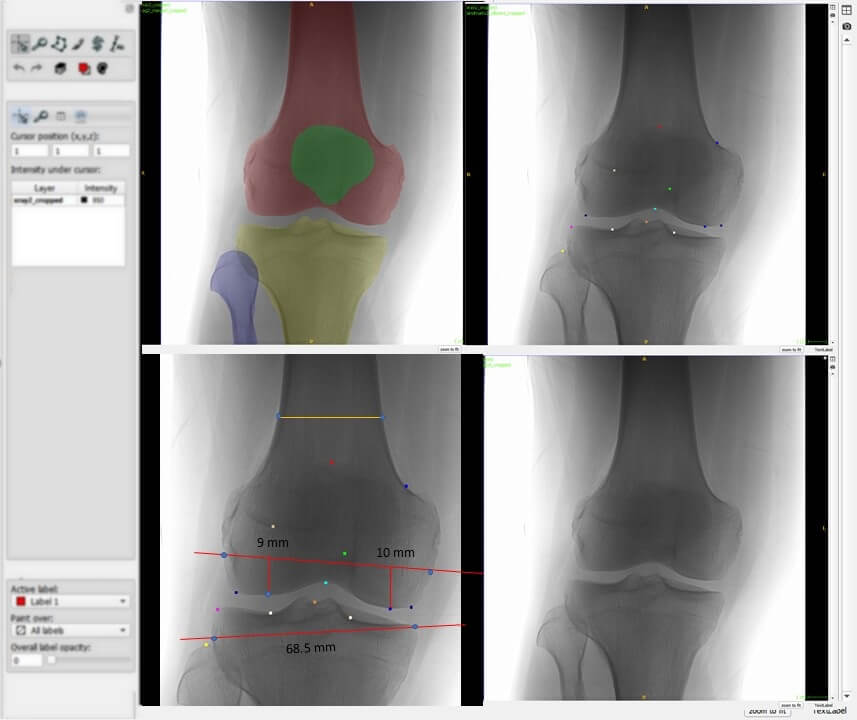 Knee Segmentation and Landmark Detection