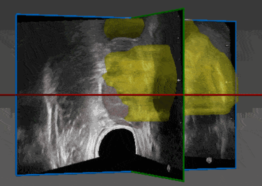 MRI-to-Ultrasound Fusion