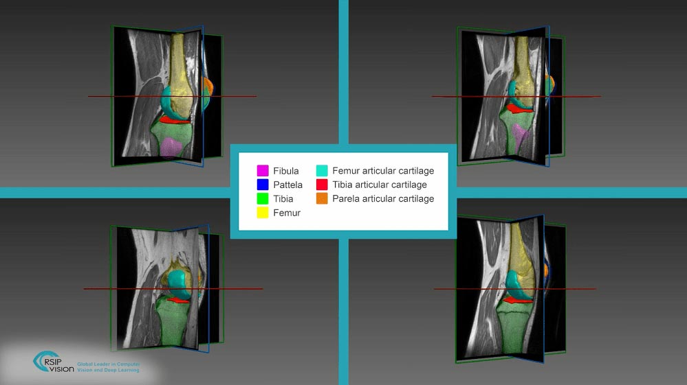 Automated Assessment of Cartilage Damage